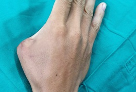 Lấy ngón chân nối thành công vào ngón tay bị mất